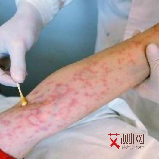 艾滋病多久开始发烧温度多少