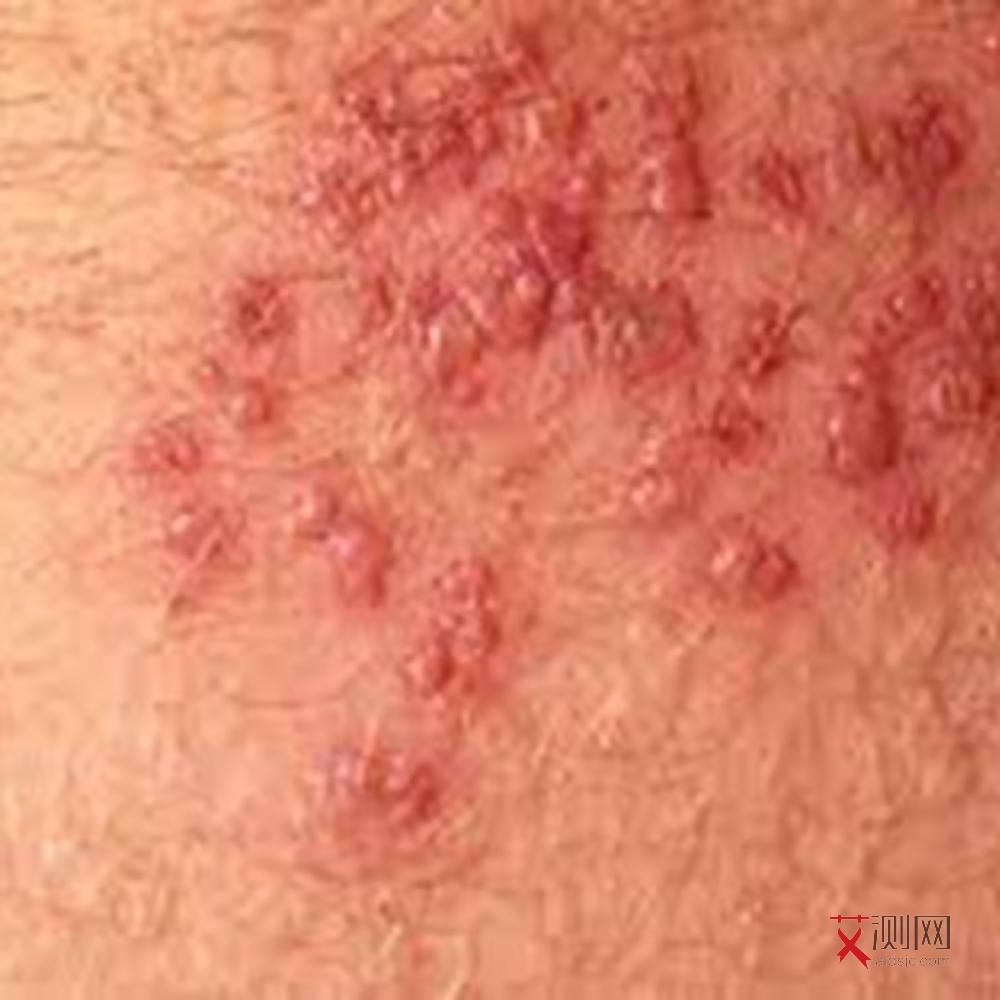 怎么可以检查自己有没有得艾滋病