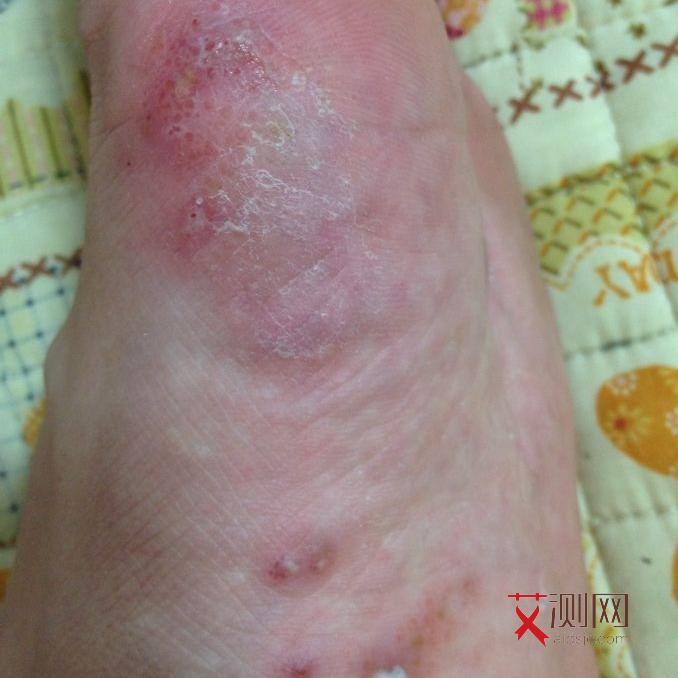 艾滋病 几个阶段