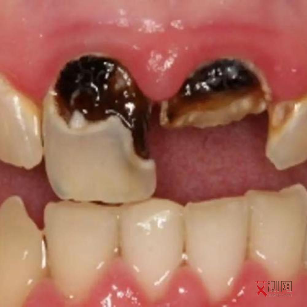 艾滋病患者最明显的症状是哪种情况