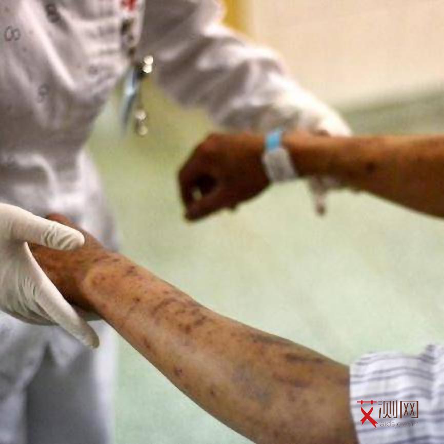 艾滋病多久发病的症状表现有哪些