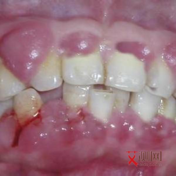 艾滋病不会死吗