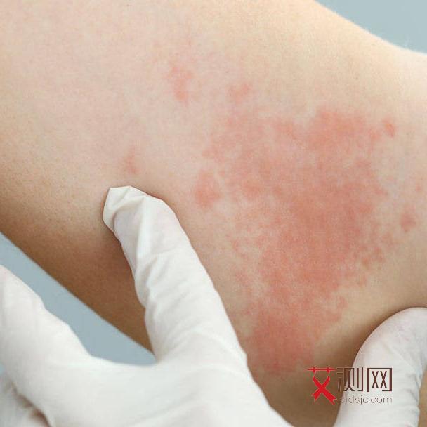 艾滋病身上起疙瘩图片怎样预防艾滋病传染