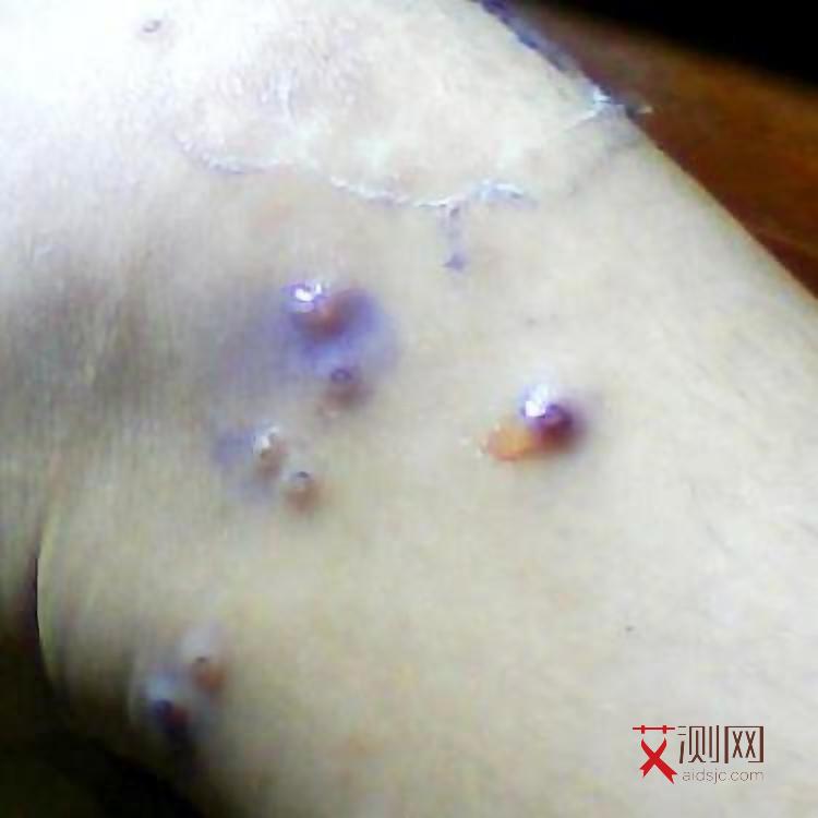 害怕艾滋病吓出病了