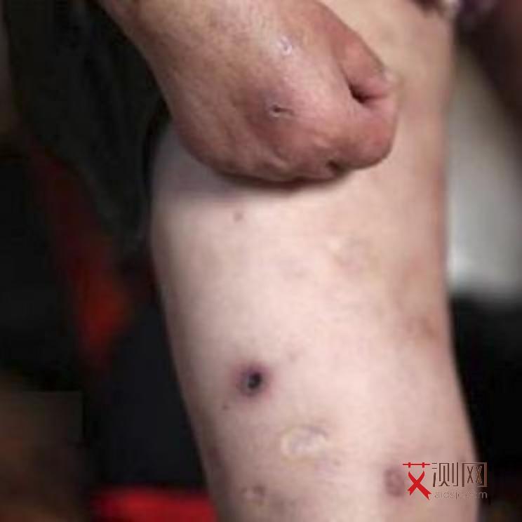 怎么检测有没有艾滋病毒