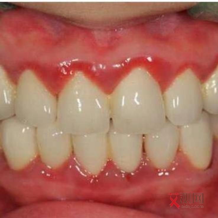 艾滋病口腔病变什么时候出现