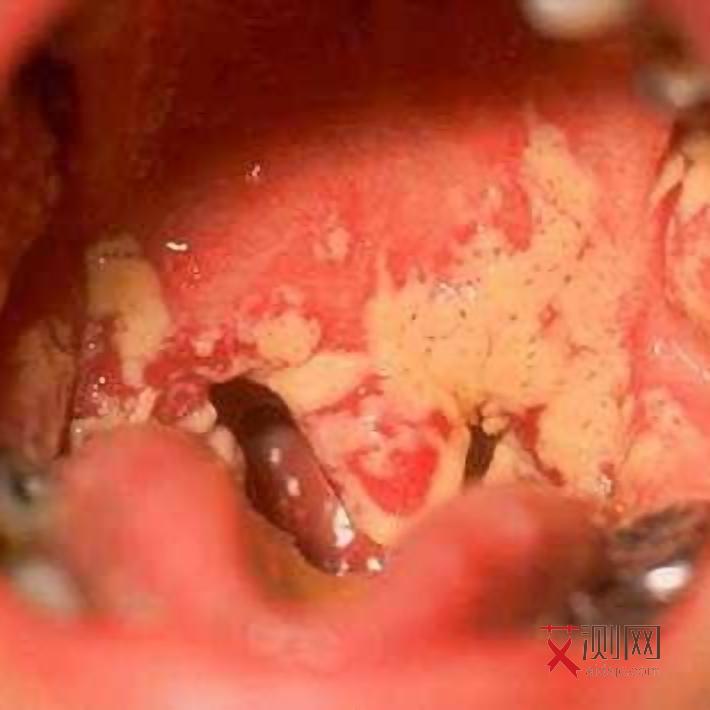 男的艾滋病有什么症状 早期症状