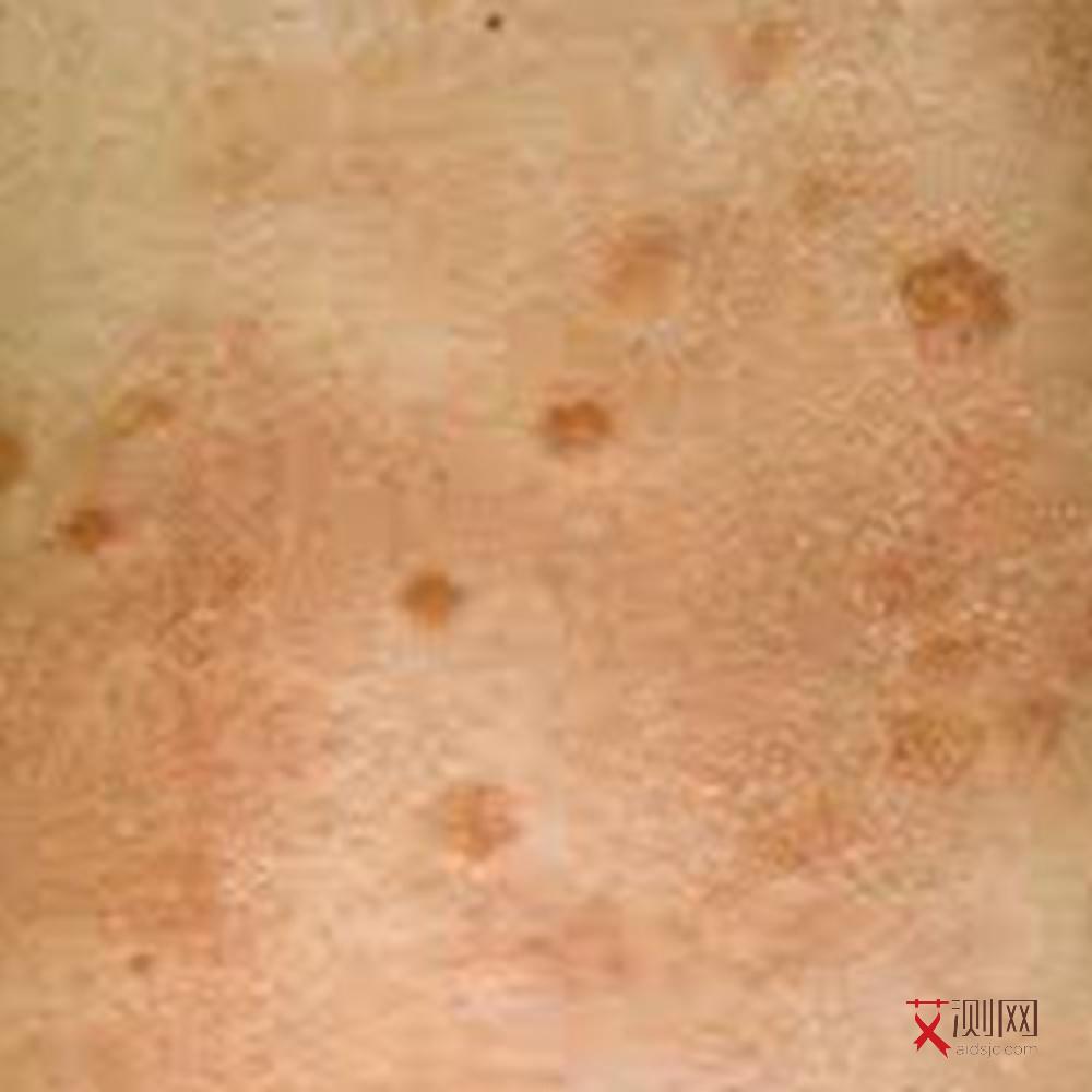 艾滋病患者多久会有症状呢女性