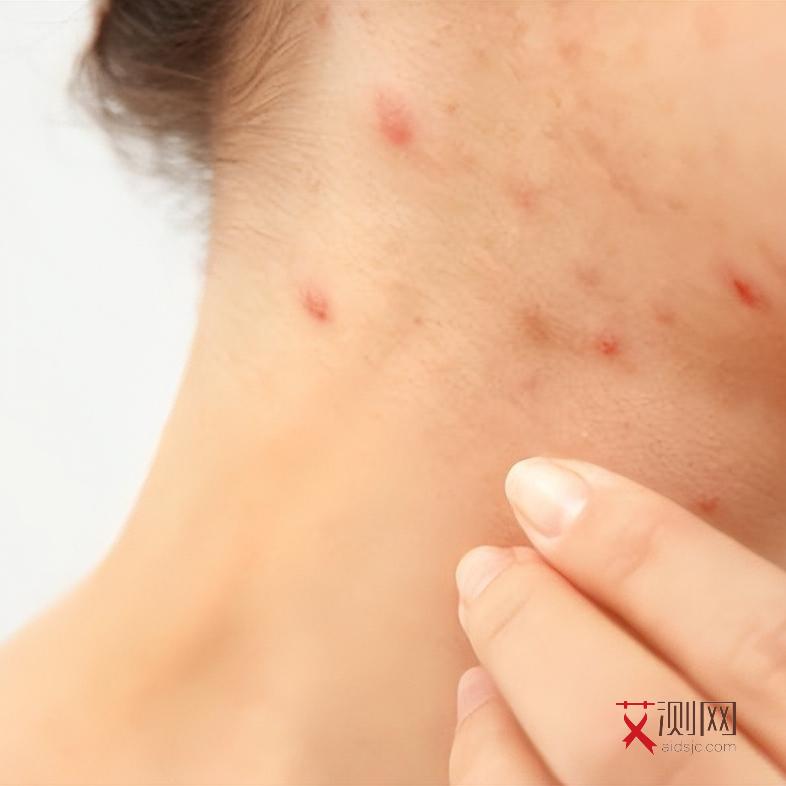 艾滋病感染多久身上长红点