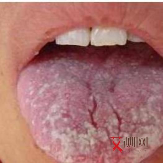 艾滋病女生的症状有哪些表现和症状