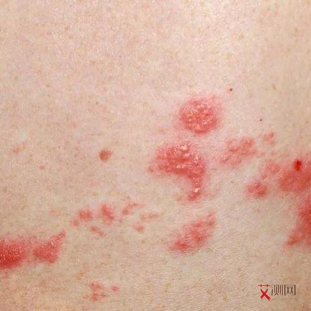 高危3个月后阴性可以排除艾滋病吗吃阻断药影响吗