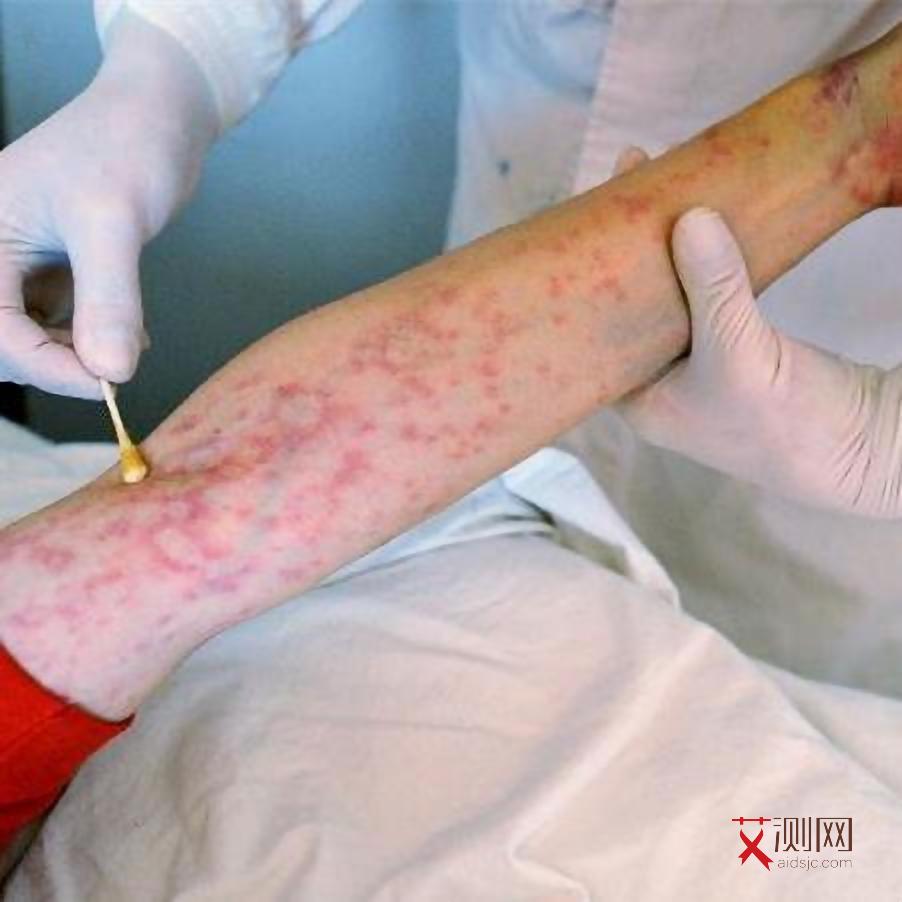 艾滋病初期会有出血点吗会传染吗