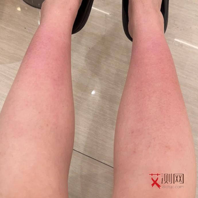 艾滋病溃疡多久自己恢复好了