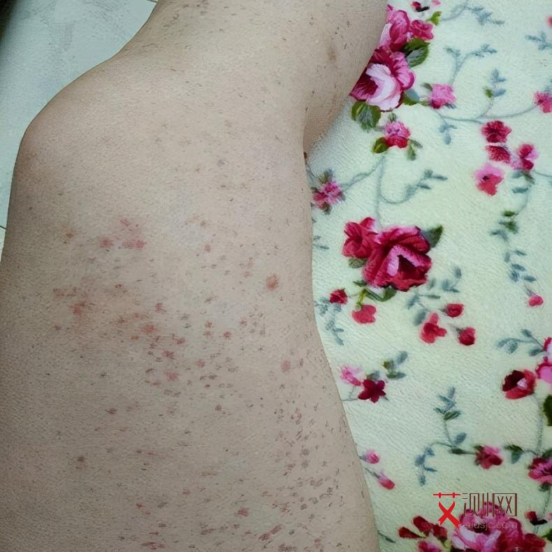 怎么检测自己是否感染艾滋病了