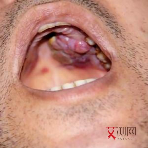 的了艾滋病皮肤会出现什么情况