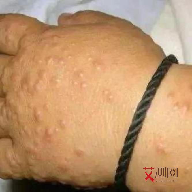 艾滋病的症状表现有哪些症状图片男性女性比例