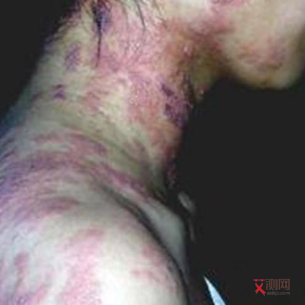 艾滋病梅毒多久发病