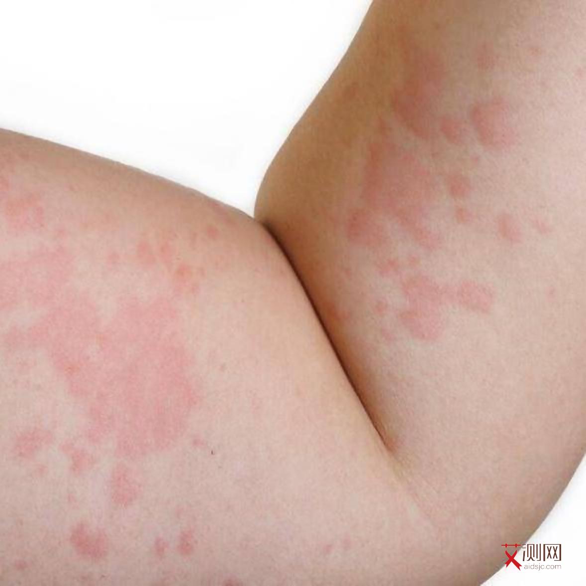 牙龈出血碰到艾滋病血会传染吗图片