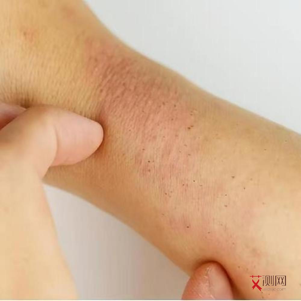 艾滋病感染多久会出现咳嗽现象