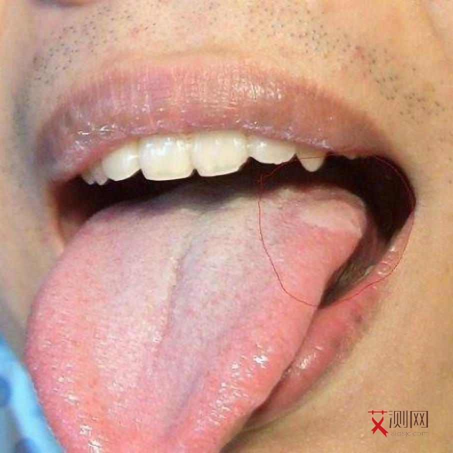 艾滋病人身上起的疙瘩是什么样式的图片