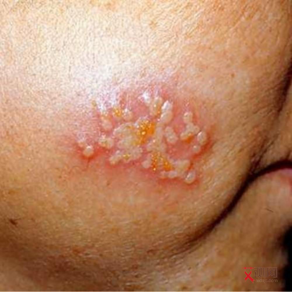 女性艾滋病患者特征有哪些图片和症状