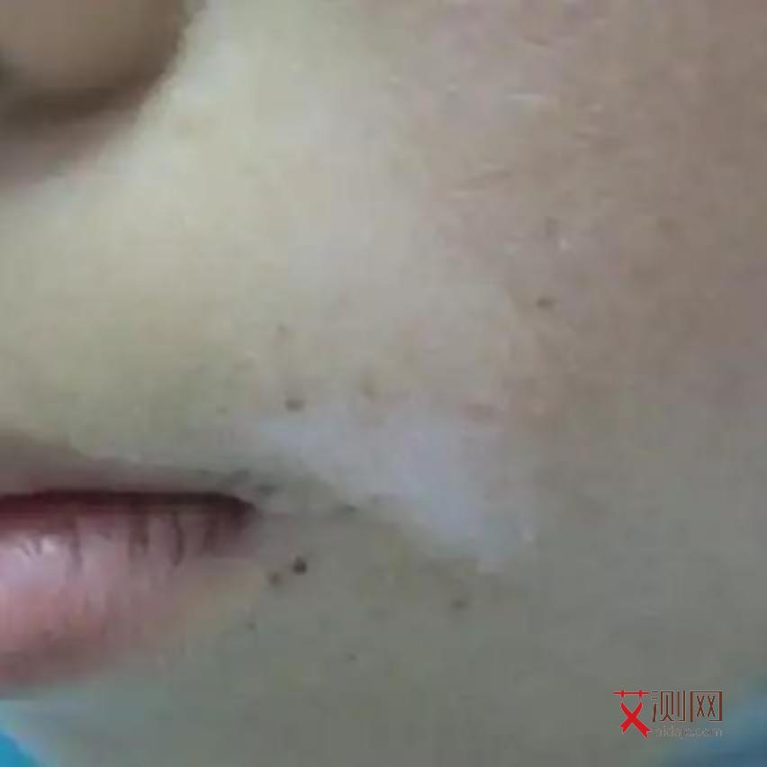 艾滋病发烧什么症状会出现头晕