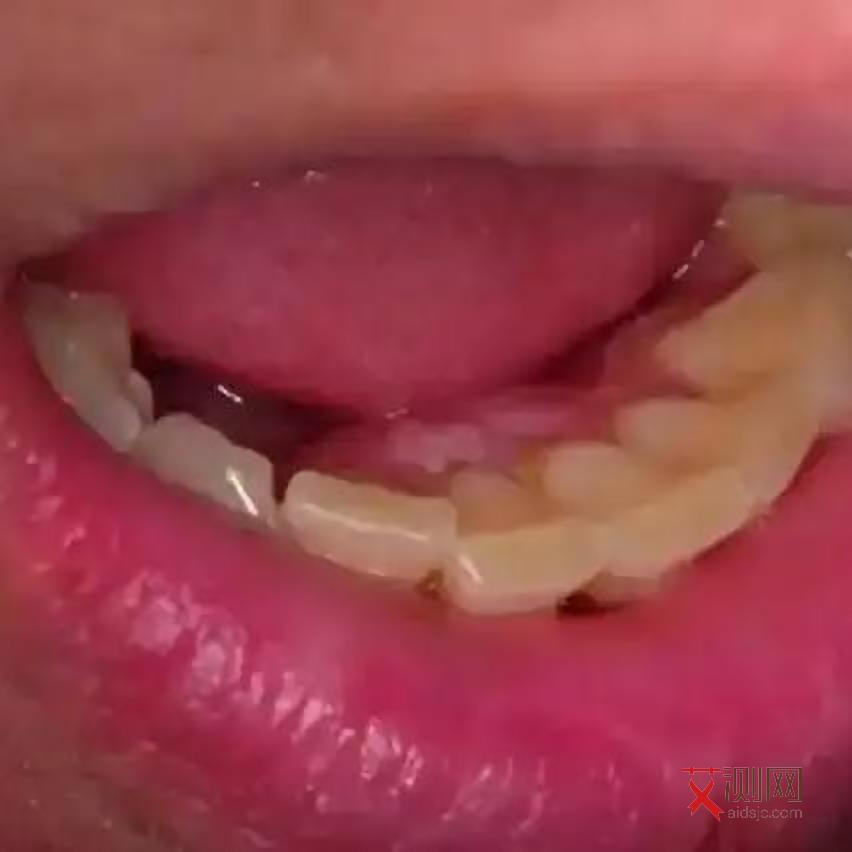 艾滋病抗体阴性是不是就是没有艾滋病