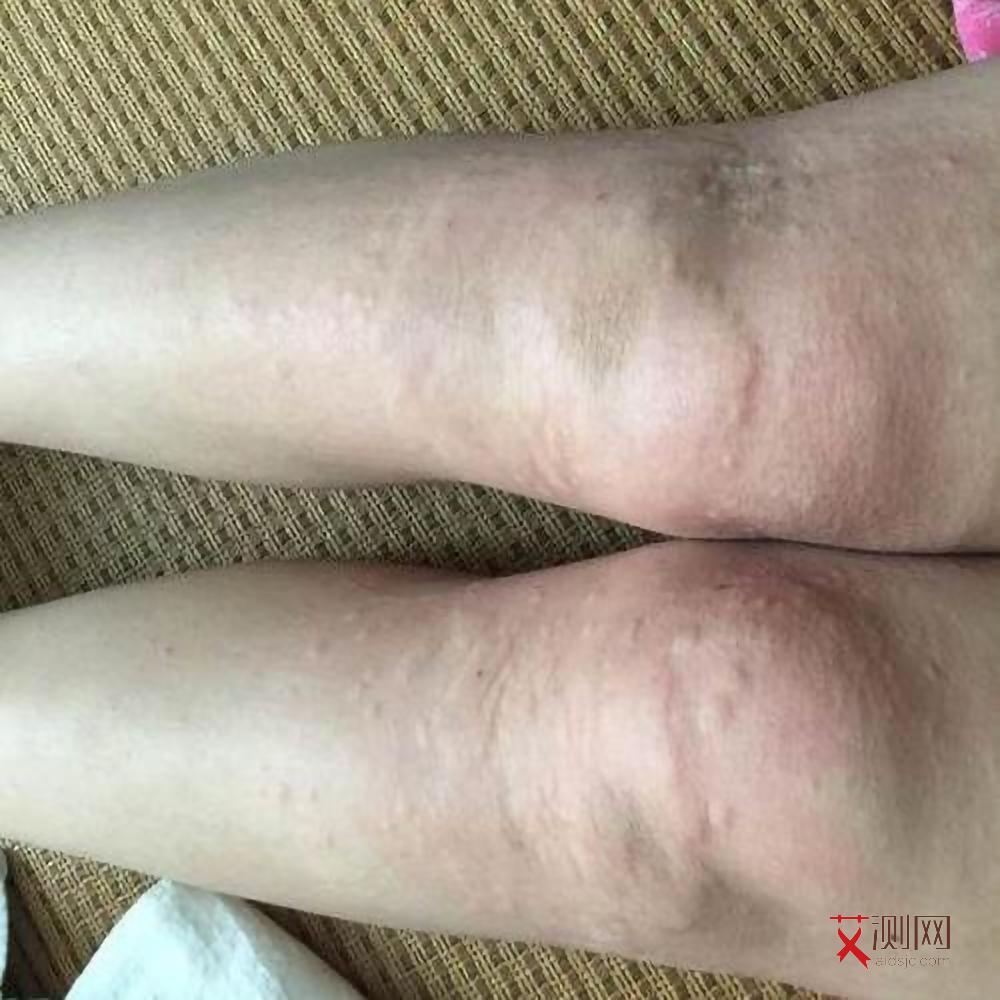 艾滋病的症状是啥症状啊