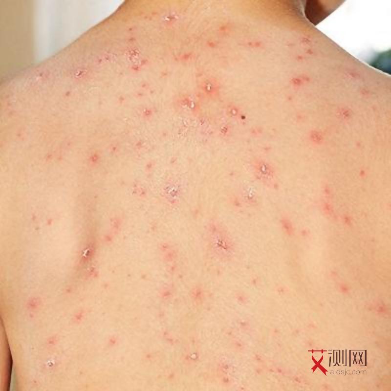 艾滋病女性表现图片高清