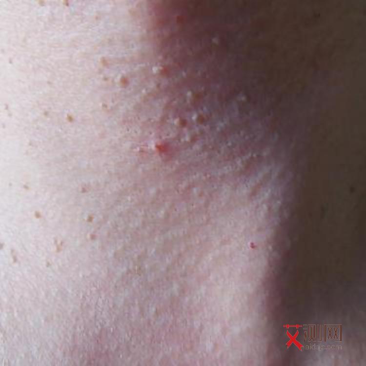 艾滋病前期会长痘痘吗会痒吗