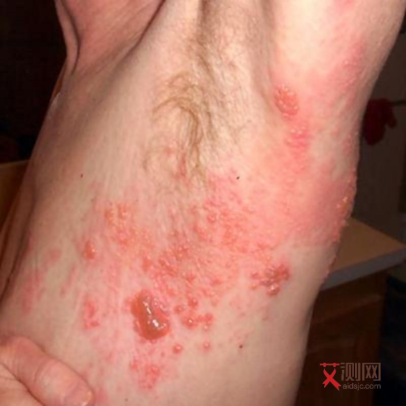 艾滋病一般多久会有症状