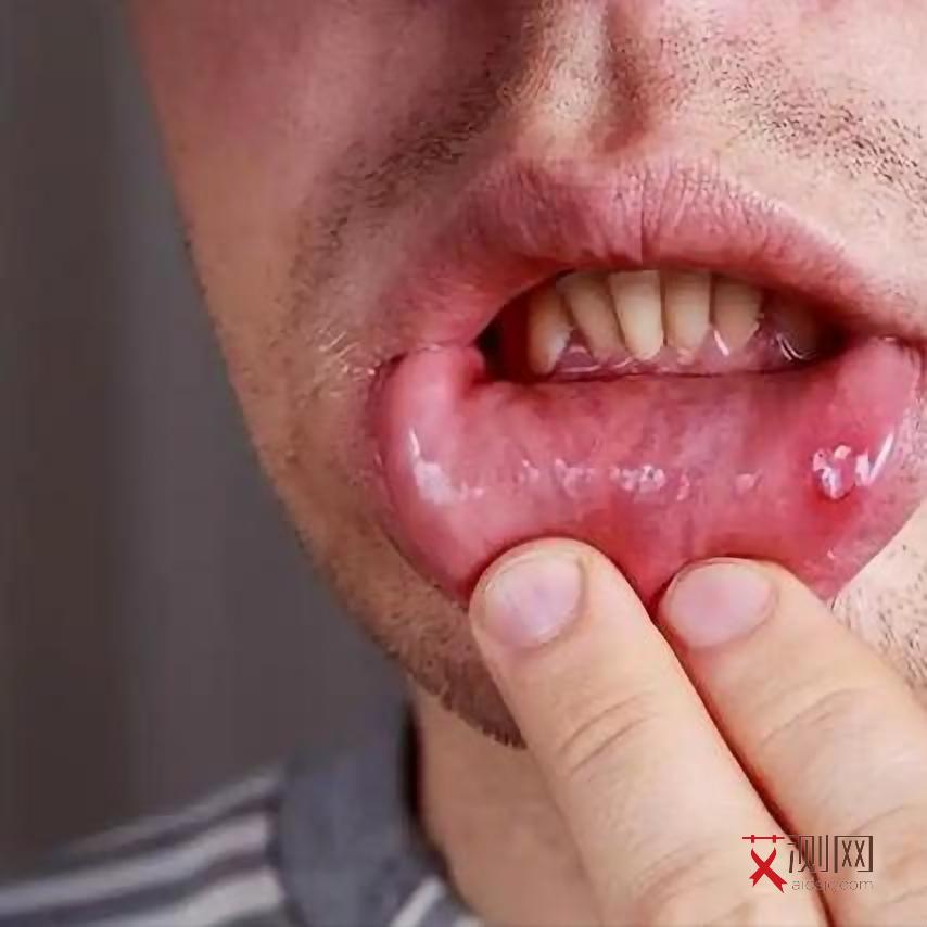 艾滋病症皮疹图片和症状图片