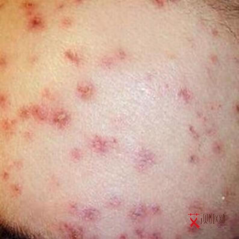 得了艾滋病最明显的症状是什么样的