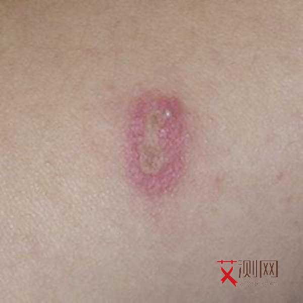 艾滋病初期全身痒吗图片