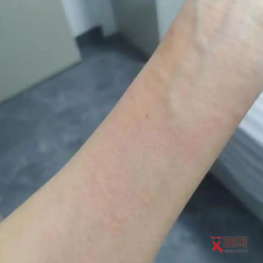 艾滋病初期皮肤表现特征