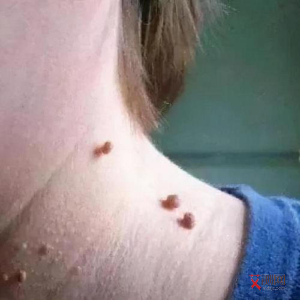 艾滋病早期真实照片图片高清大全下载