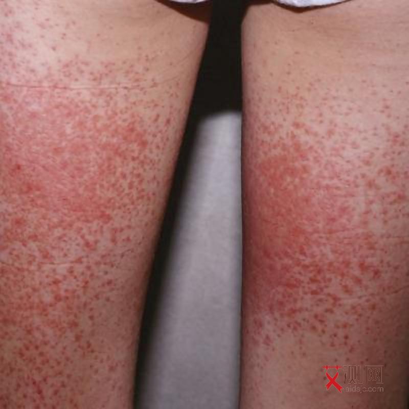 艾滋病的初期症状会持续多久呢图片女性