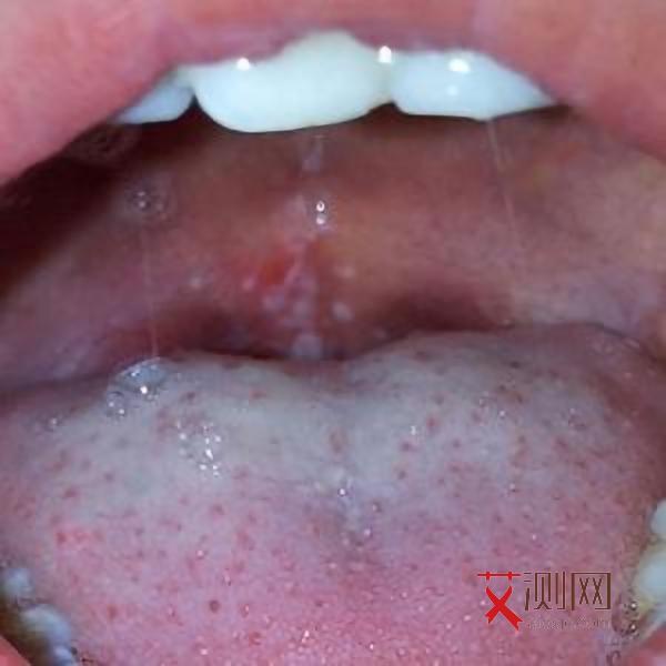 艾滋病前期浑身痒吗会痒吗