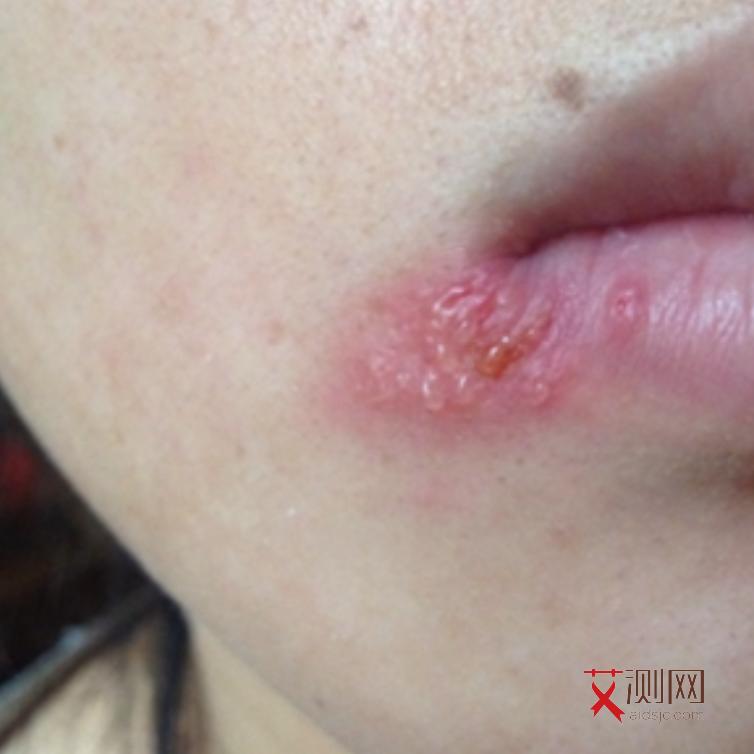 艾滋病的症状及表现男性怎么治疗