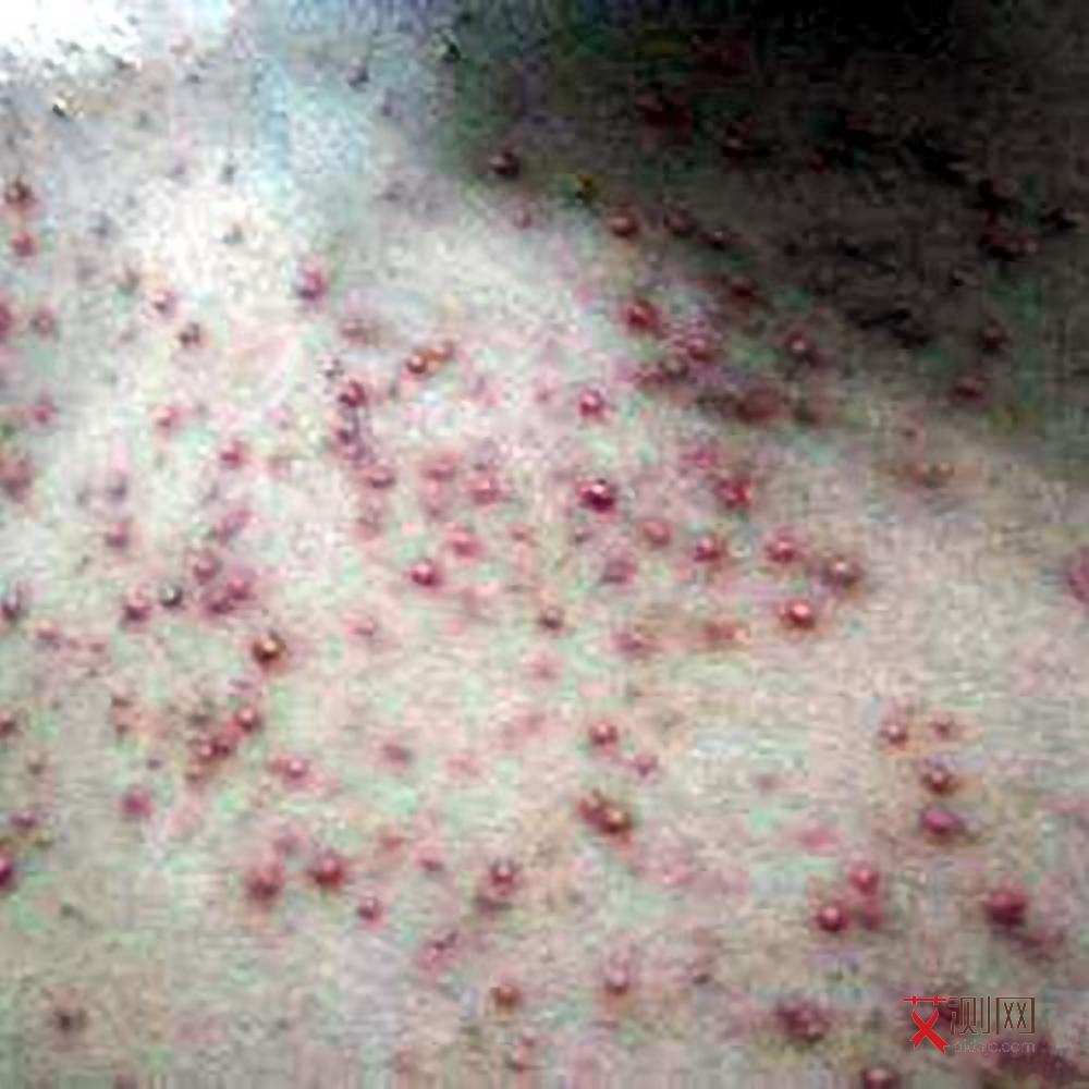 艾滋病会不会没有症状就得了癌症