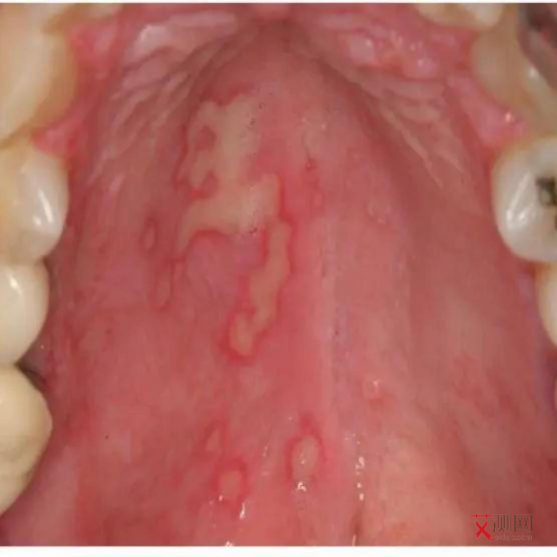 艾滋病会有什么症状图片