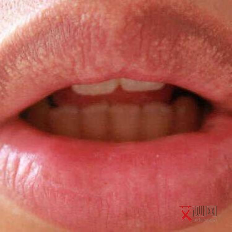 艾滋病初期发烧会反复吗多久