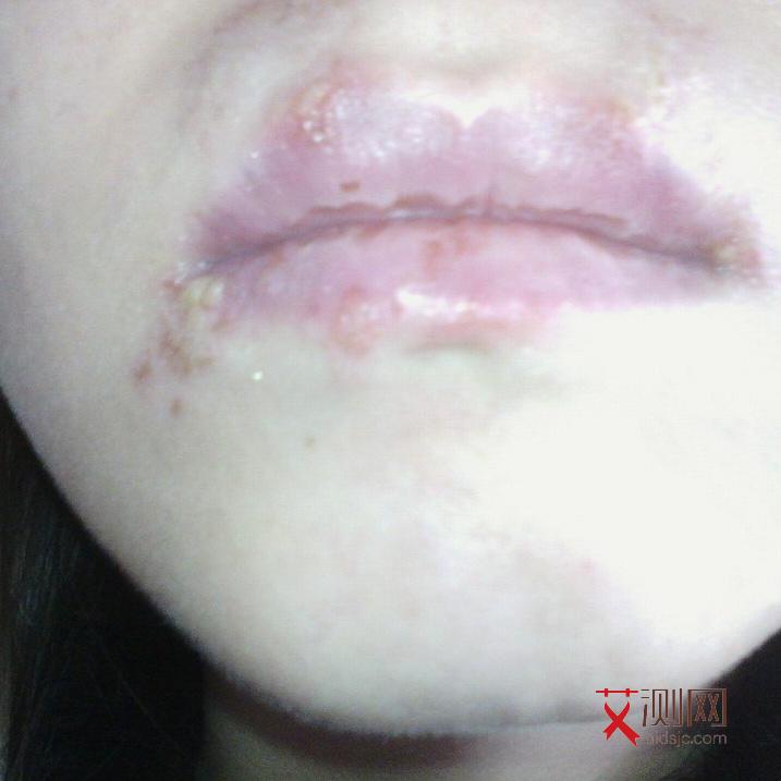 艾滋病的皮肤病表现有哪些