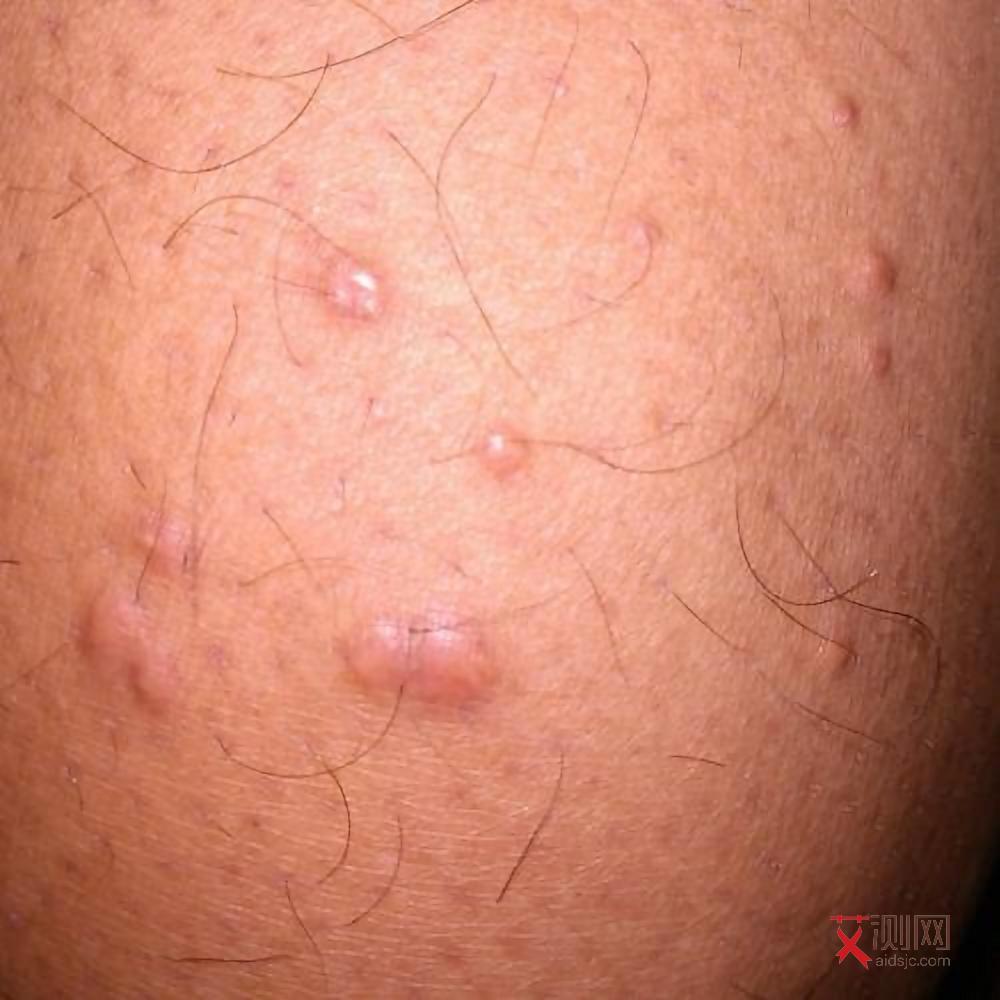 艾滋病有哪些前兆