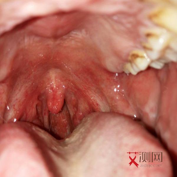 艾滋病会一下子就发作吗女性