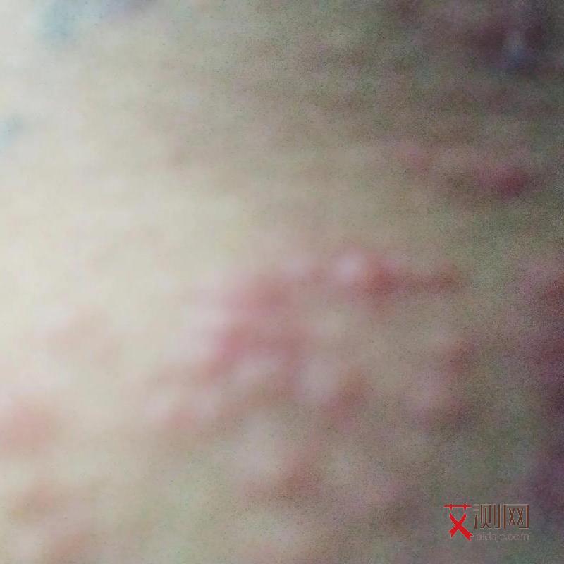 艾滋病的初期会不会有皮肤过敏现象