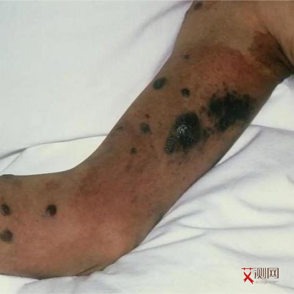 艾滋病脸上会长什么东西呢