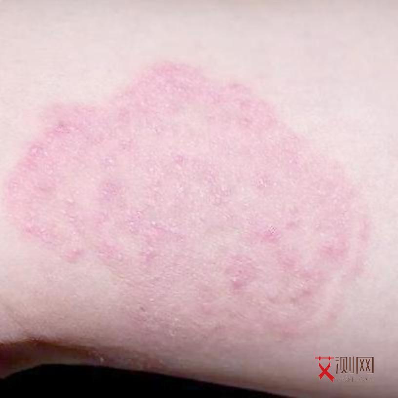 初次感染艾滋病多久有传染性