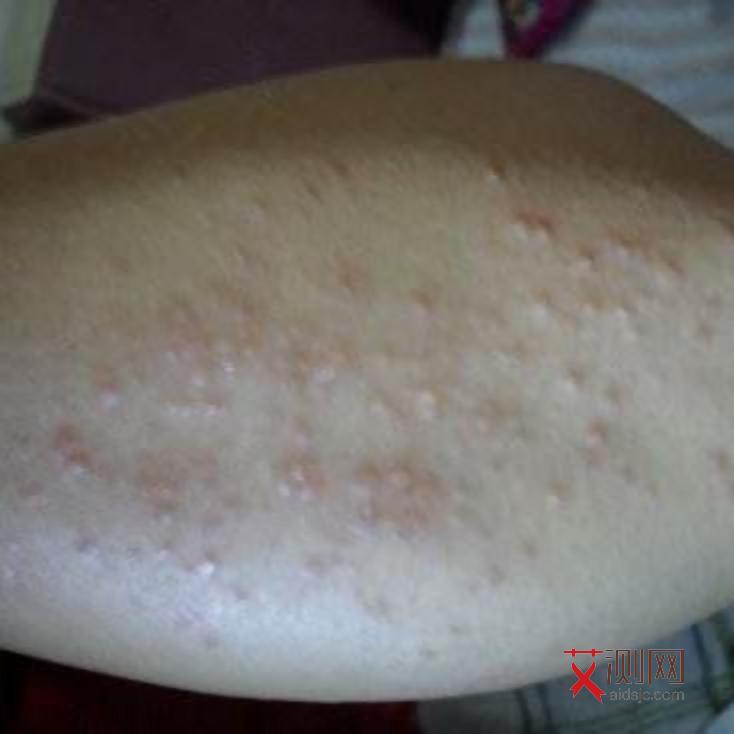 艾滋病皮疹到底什么样子图片和症状
