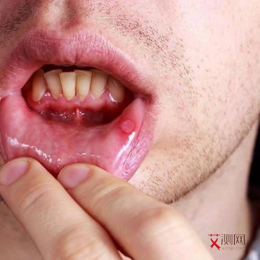 艾滋病初期小红点几天会消失